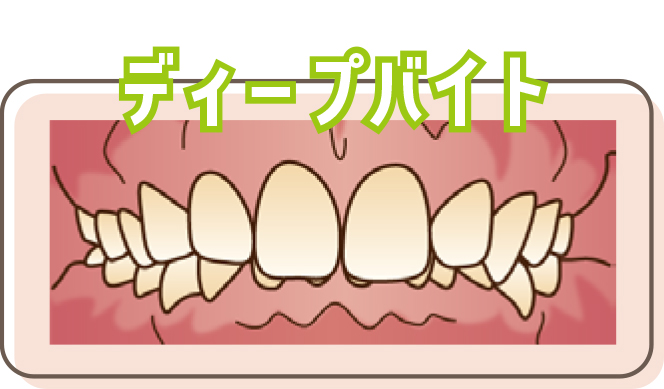 ディープバイト