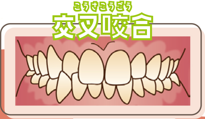 交叉咬合