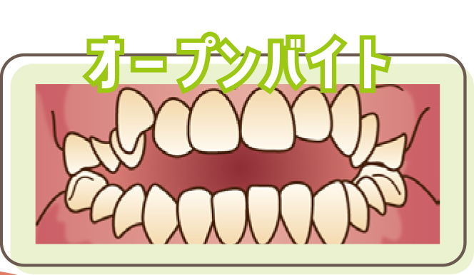 オープンバイト