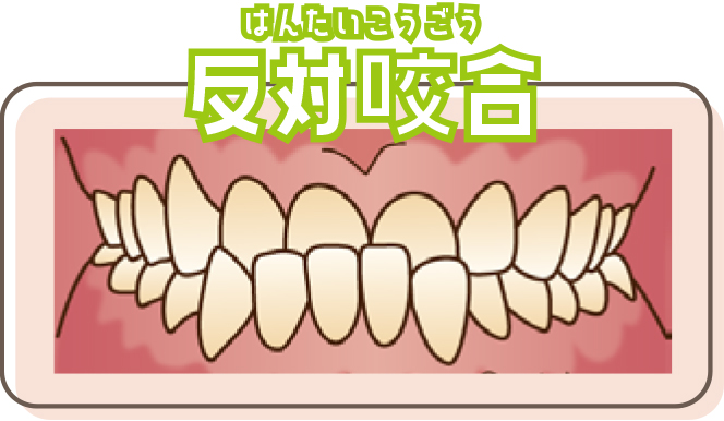 反対咬合